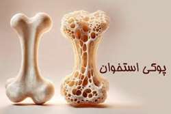 از باورهای نادرست تا حقیقت که  درباره پوکی استخوان باید بدانیم